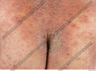 photo texture of scarred skin 0004